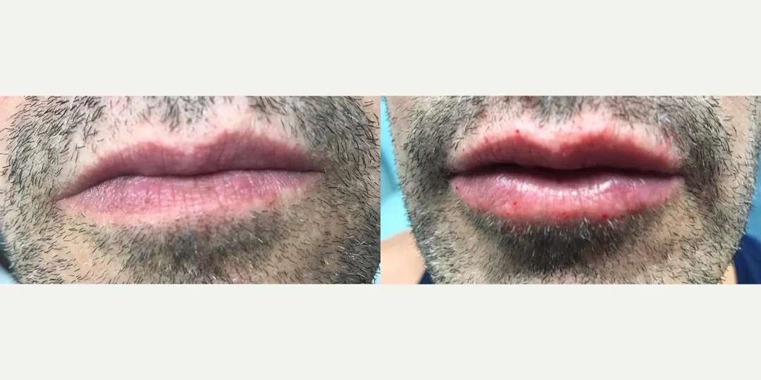 Juvaderm filler before & after from Beaches Facial Plastic Surgery - the top place for juvaderm dermal filler treatment in Jacksonville or Northeast Florida. 