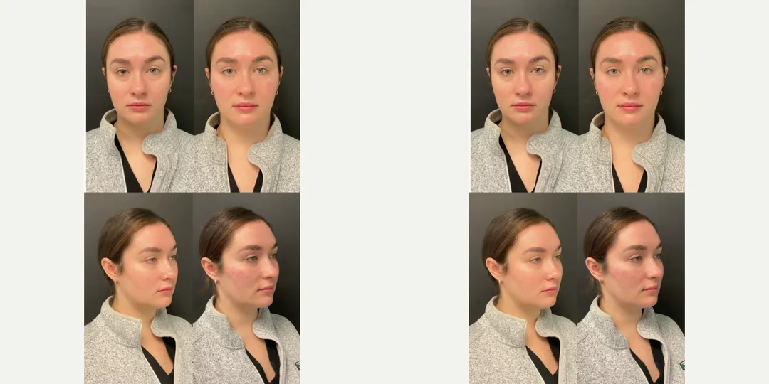 Juvaderm filler before & after from Beaches Facial Plastic Surgery - the top place for juvaderm dermal filler treatment in Jacksonville or Northeast Florida. 