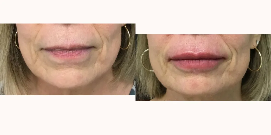Juvaderm filler before & after from Beaches Facial Plastic Surgery - the top place for juvaderm dermal filler treatment in Jacksonville or Northeast Florida. 