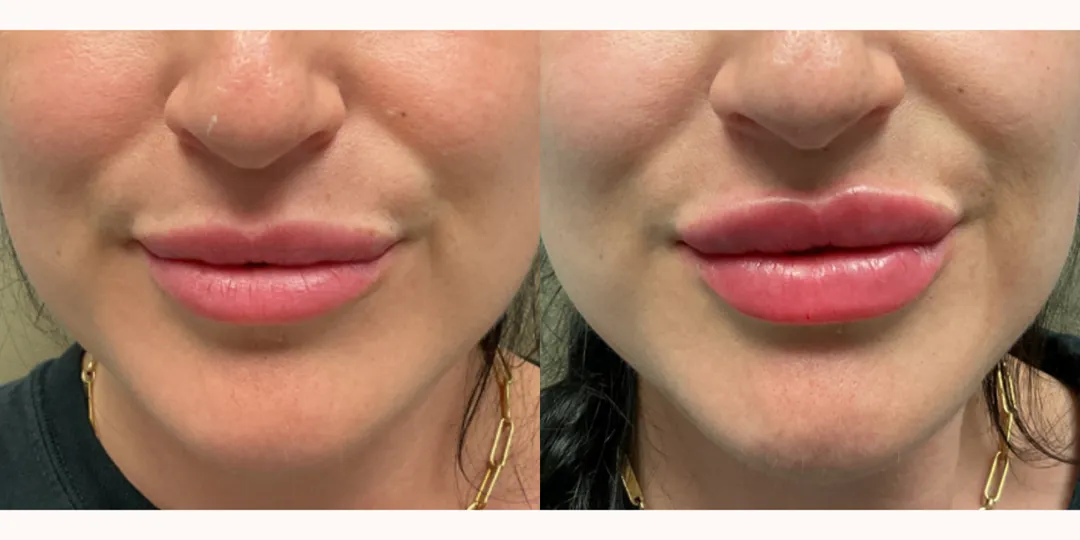 Juvaderm filler before & after from Beaches Facial Plastic Surgery - the top place for juvaderm dermal filler treatment in Jacksonville or Northeast Florida. 