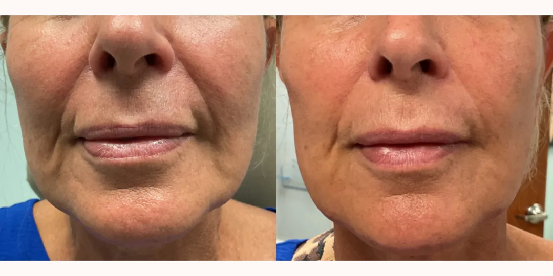 Juvaderm filler before & after from Beaches Facial Plastic Surgery - the top place for juvaderm dermal filler treatment in Jacksonville or Northeast Florida. 