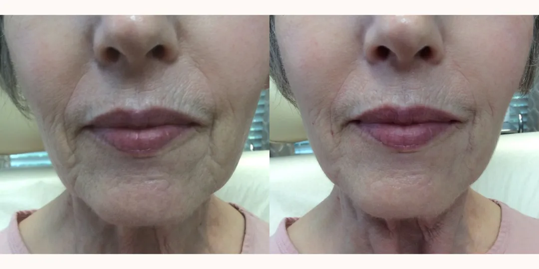Juvaderm filler before & after from Beaches Facial Plastic Surgery - the top place for juvaderm dermal filler treatment in Jacksonville or Northeast Florida. 