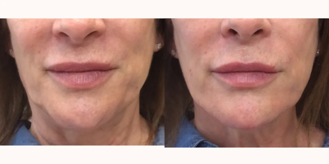 Juvaderm filler before & after from Beaches Facial Plastic Surgery - the top place for juvaderm dermal filler treatment in Jacksonville or Northeast Florida. 