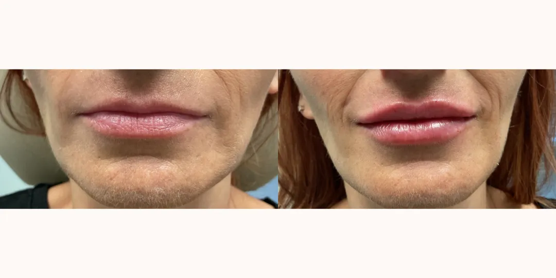 Juvaderm filler before & after from Beaches Facial Plastic Surgery - the top place for juvaderm dermal filler treatment in Jacksonville or Northeast Florida. 