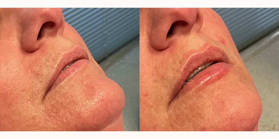 Juvaderm filler before & after from Beaches Facial Plastic Surgery - the top place for juvaderm dermal filler treatment in Jacksonville or Northeast Florida. 