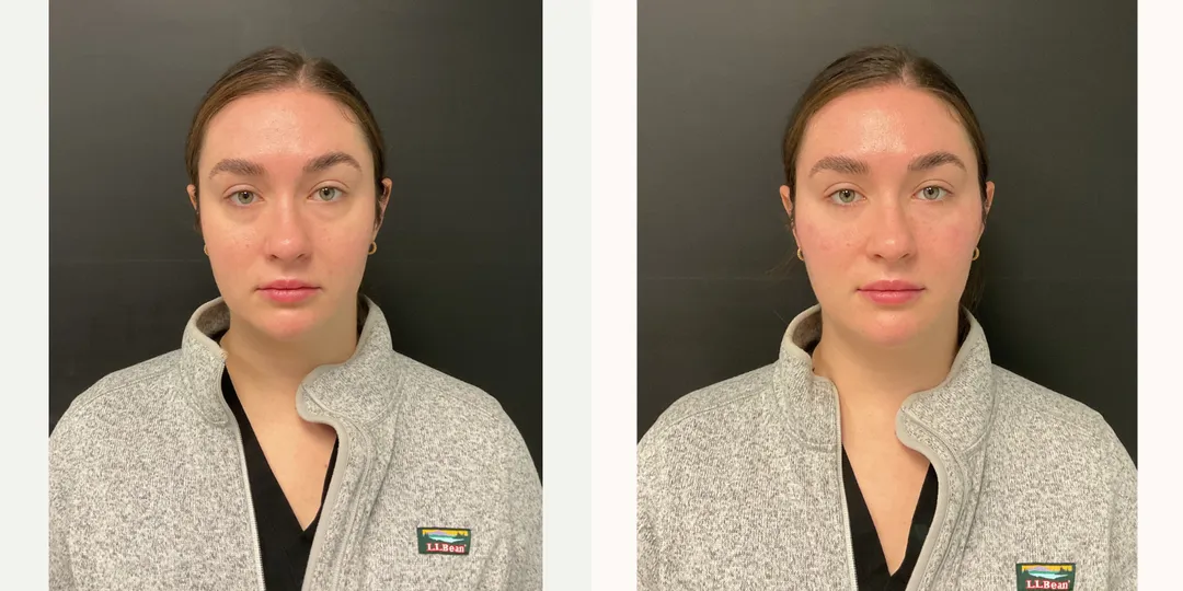 Juvaderm filler before & after from Beaches Facial Plastic Surgery - the top place for juvaderm dermal filler treatment in Jacksonville or Northeast Florida. 