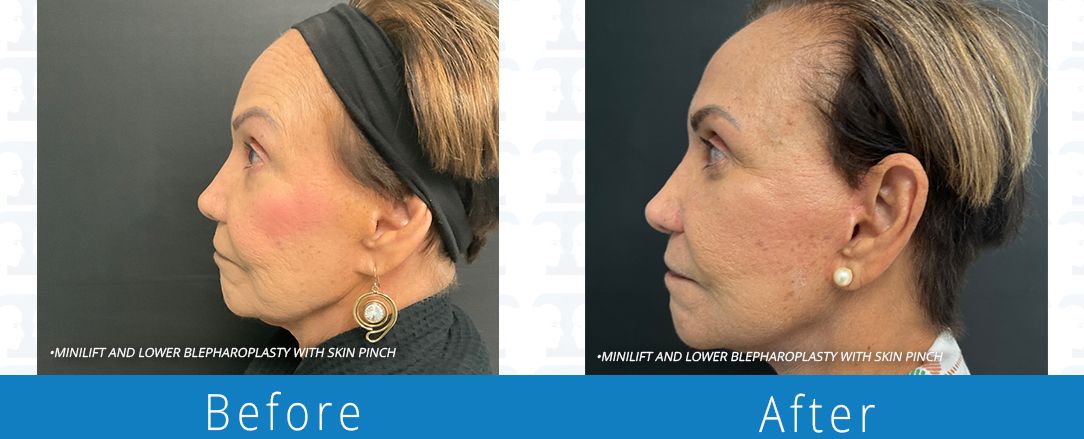 Eyelid surgery before & after  Beaches Facial Plastic & Nasal Surgery Center - the top surgeon for a blepharoplasty or eyelid surgery in Jacksonville or Northeast Florida.