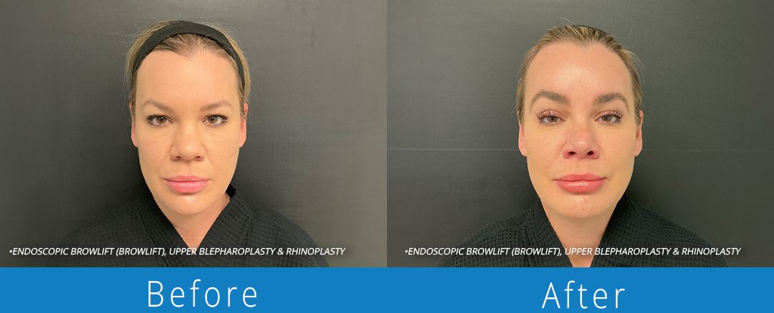 Eyelid surgery before & after Beaches Facial Plastic & Nasal Surgery Center- the top surgeon for a blepharoplasty or eyelid surgery in Jacksonville or Northeast Florida.