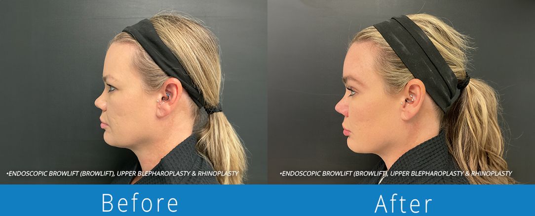 Eyelid surgery before & after  Beaches Facial Plastic & Nasal Surgery Center - the top surgeon for a blepharoplasty or eyelid surgery in Jacksonville or Northeast Florida.
