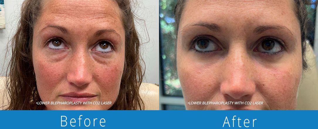 Eyelid surgery before & after  Beaches Facial Plastic & Nasal Surgery Center - the top surgeon for a blepharoplasty or eyelid surgery in Jacksonville or Northeast Florida.