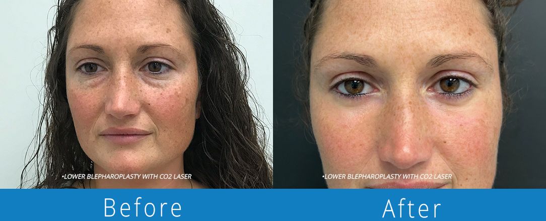 Eyelid surgery before & after Beaches Facial Plastic & Nasal Surgery Center - the top surgeon for a blepharoplasty or eyelid surgery in Jacksonville or Northeast Florida.