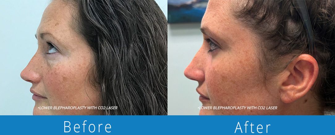 Eyelid surgery before & after  Beaches Facial Plastic & Nasal Surgery Center - the top surgeon for a blepharoplasty or eyelid surgery in Jacksonville or Northeast Florida.