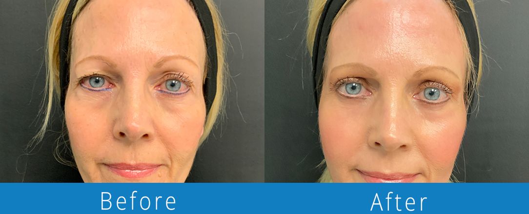 Eyelid surgery before & after Beaches Facial Plastic & Nasal Surgery Center - the top surgeon for a blepharoplasty or eyelid surgery in Jacksonville or Northeast Florida.