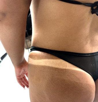 Person in a black bikini bottom, with a white sunburn line across the lower back and hip.