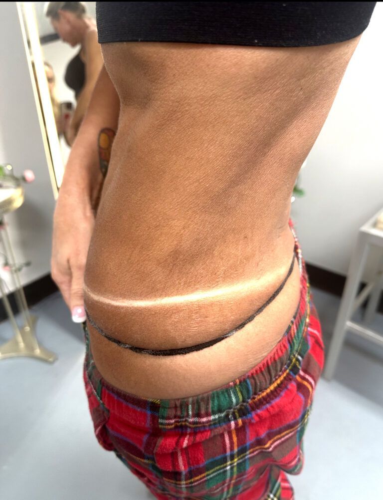 Side view of a person's waist with a prominent horizontal skin crease and red plaid pants underneath