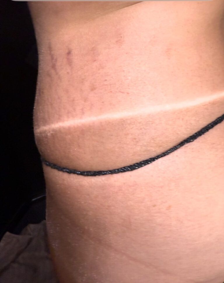 Close-up of a person’s lower leg with a black cord wrapped around the ankle.