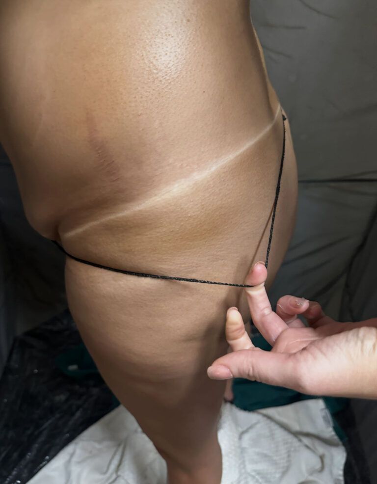 Hand measuring thigh skinfold with calipers, black cord wrapped around upper leg.
