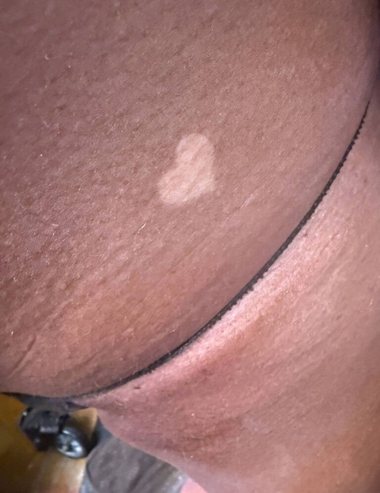 Close-up of a small light-colored patch on dark skin near a curved black strap.