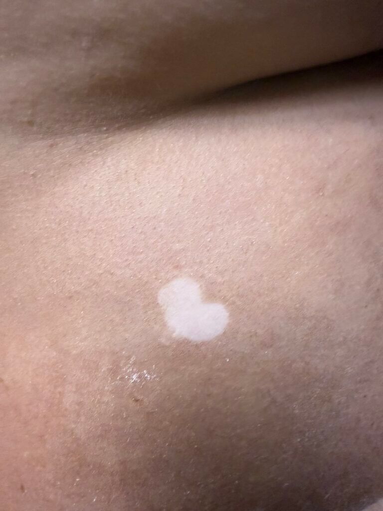Close-up of skin with a small white patch on a brown surface.