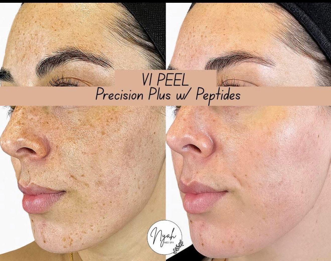 Side-by-side photos of a face show before and after results of a VI Peel. The “after” photo shows clearer skin.