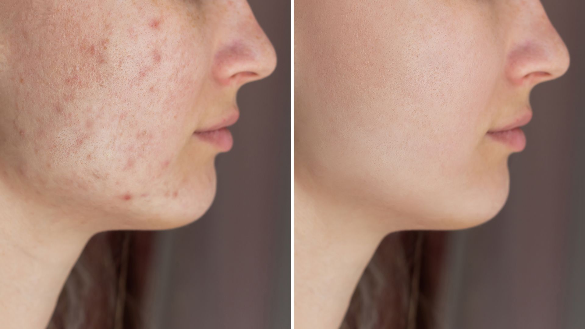 a before and after photo of a woman 's face with acne .
