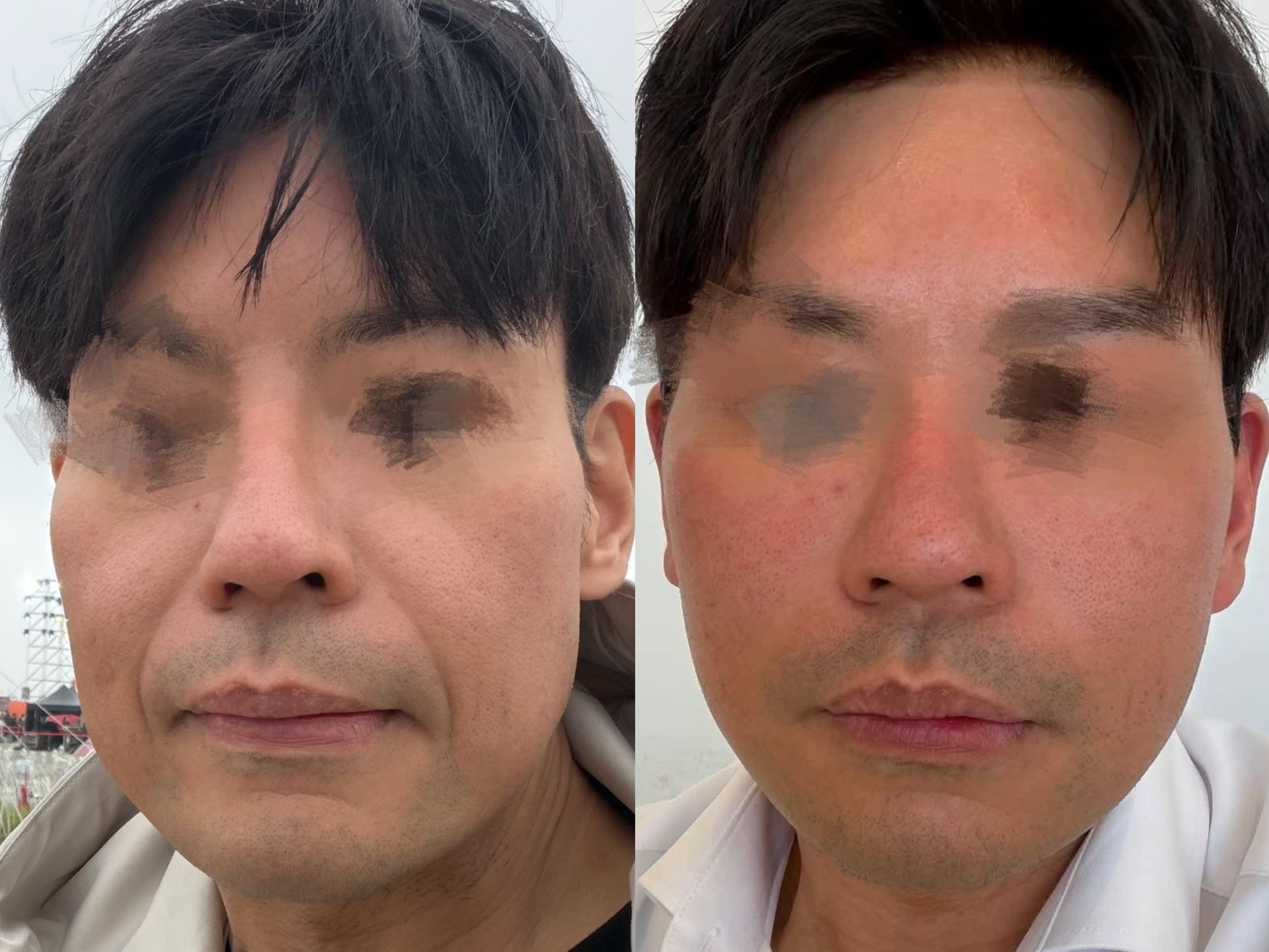 facelift 拉皮