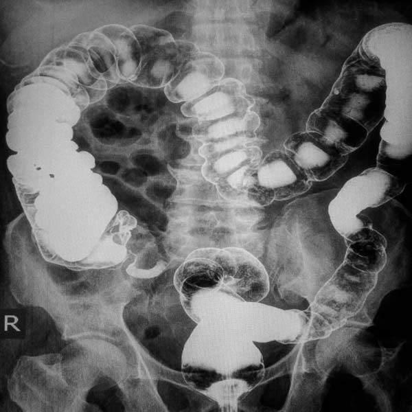 A black and white x-ray of colon showing need for Functional and Integrative Diverticulosis Therapy That Address The Cause of Patient Symptoms by Salerno Wellness in Manhattan, NY and Connecticut