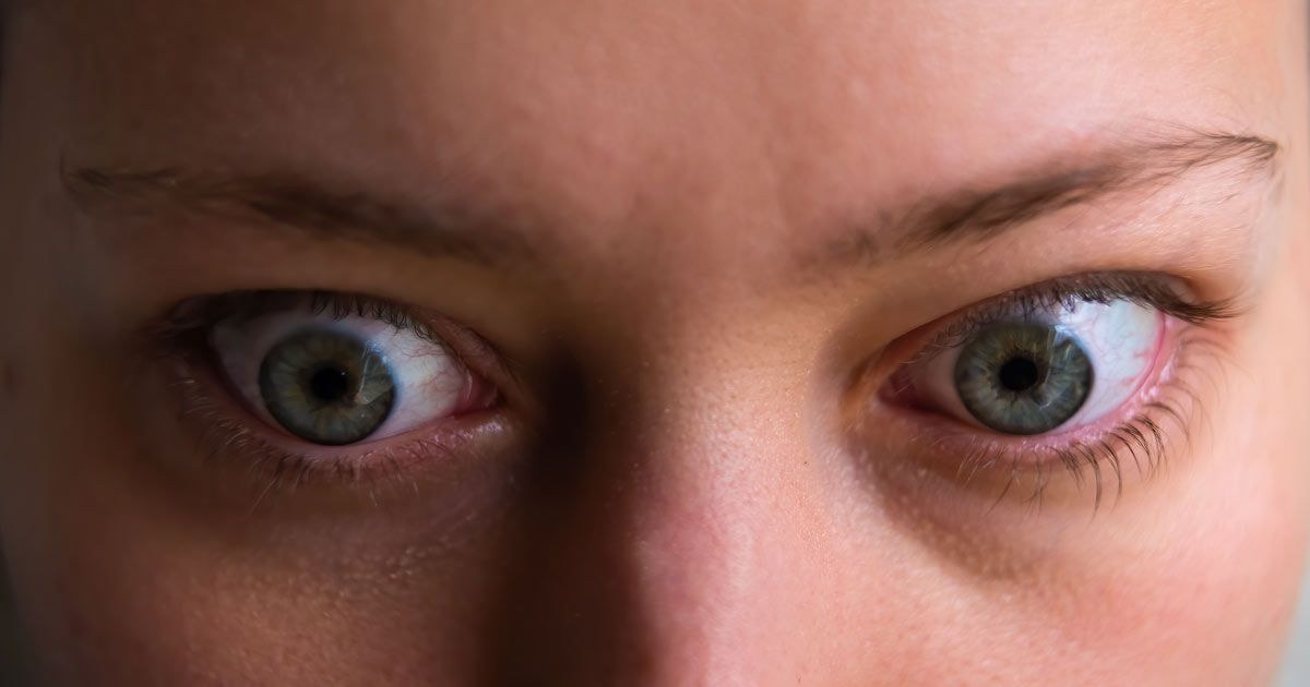 Bulging Eyes are a Symptom of Graves' Disease Bulging Eyes are a Symptom of Graves' Disease and a sign of a need for Graves' Disease Treatments NYC - Dr. John Salerno