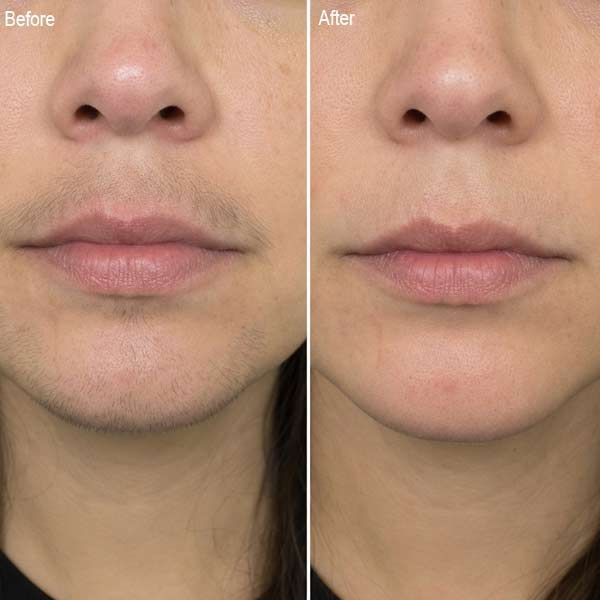 Side-by-side before and after close-up of a lower face, showing smoother skin and a lighter mustache area from Laser Hair Removal.