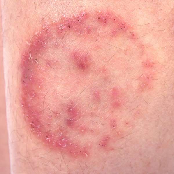 A close up of a rash on a person 's leg from a ring worm indicating Parasite Infection Treatments