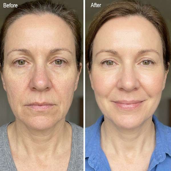 Before-and-after face photos showing a smoother, brighter complexion in the after image after Skin Resurfacing and Rejuvenation Treatment