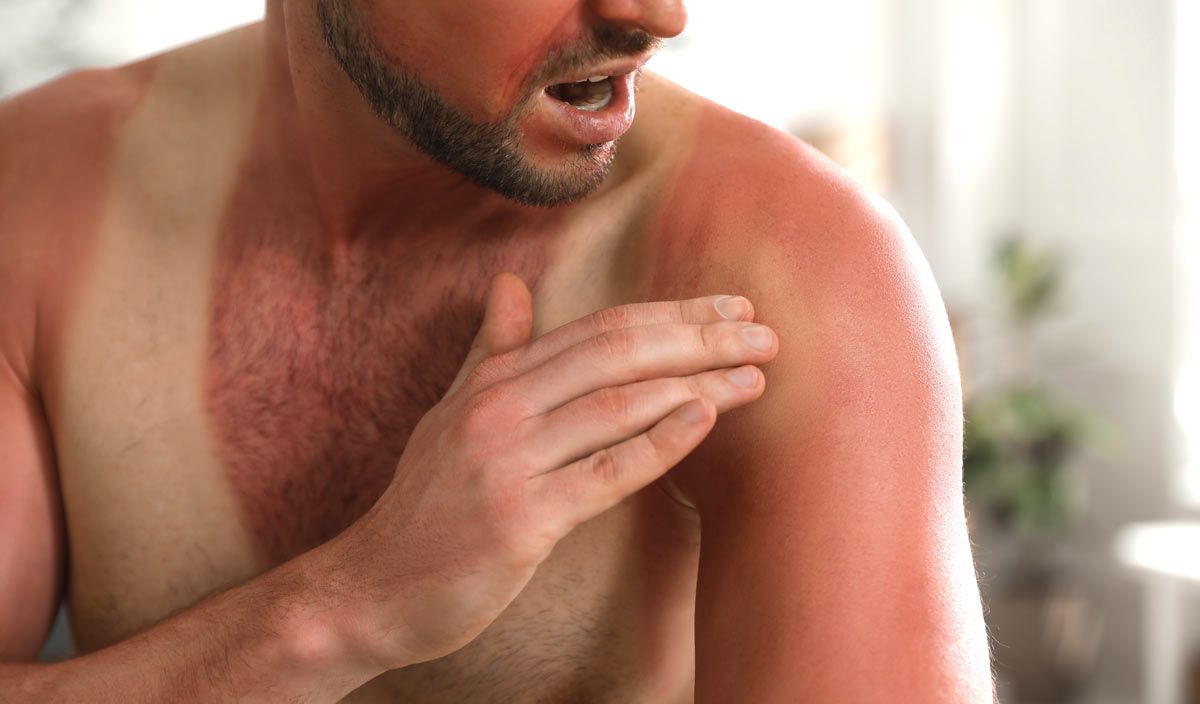 A man with severe sunburn needs a Summer Skin Protection and Repair Plan