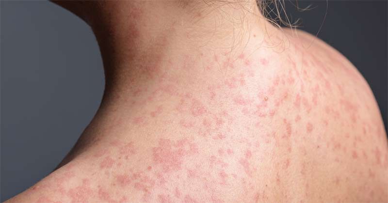 Back of a person with measles. Vitamin A for Measles and Skin Health