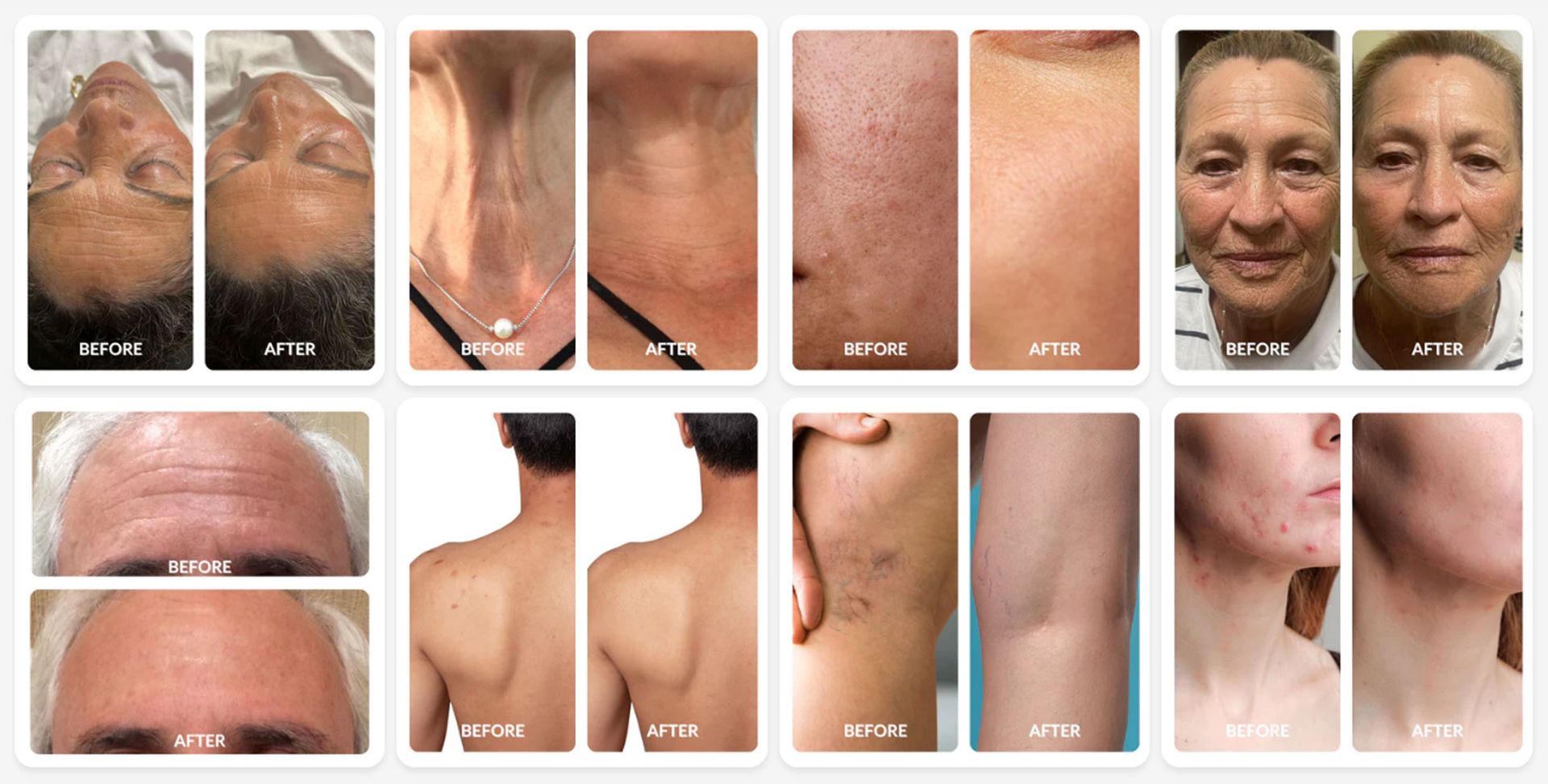 Before and After Pictures Click to Enlarge before and after images after light therapy Red Light Therapy NYC - Dr. John Salerno Phototherapy Treatments with Red and Blue Light at Salerno Wellness in Manhattan, NY and Connecticut