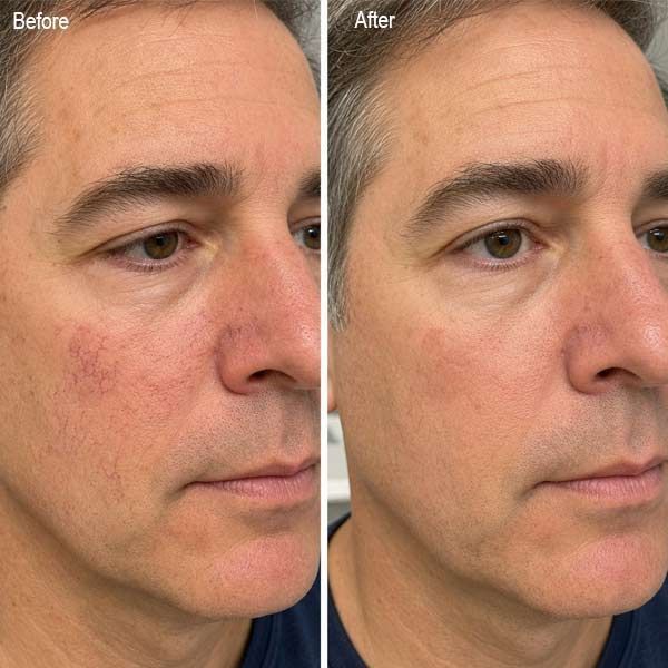 Side-by-side before-and-after close-up of a man's face, showing smoother skin and fewer spider veins after treatment
