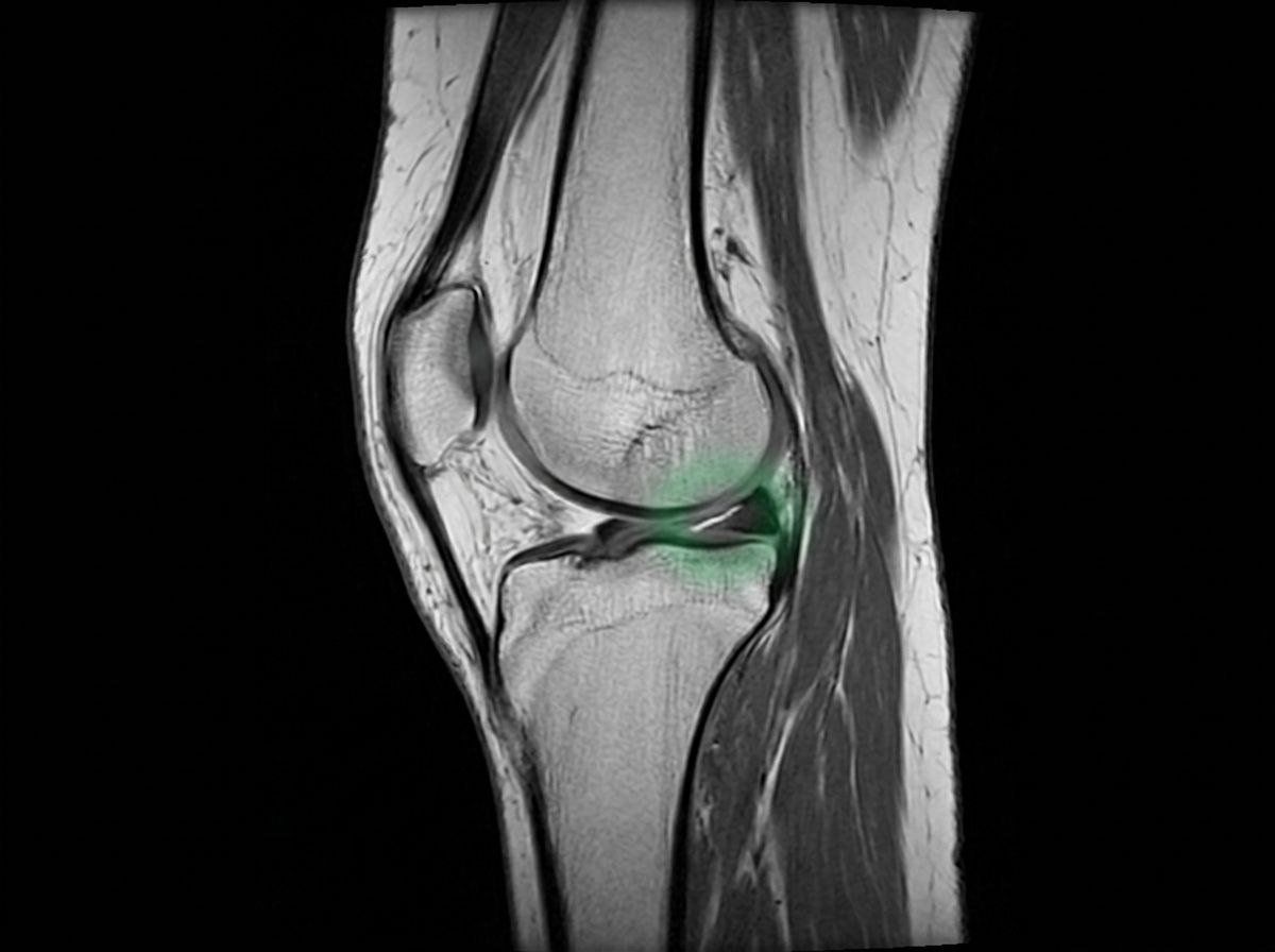Resonancia magnética de rodilla que muestra una rotura del menisco medial
