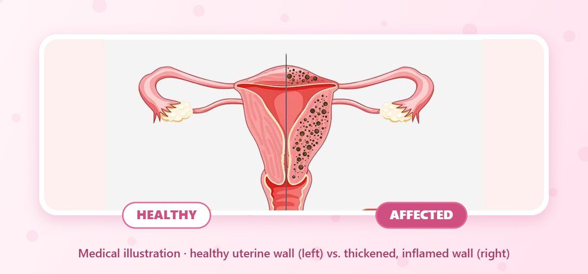 Endometrial Ablation – medical illustration