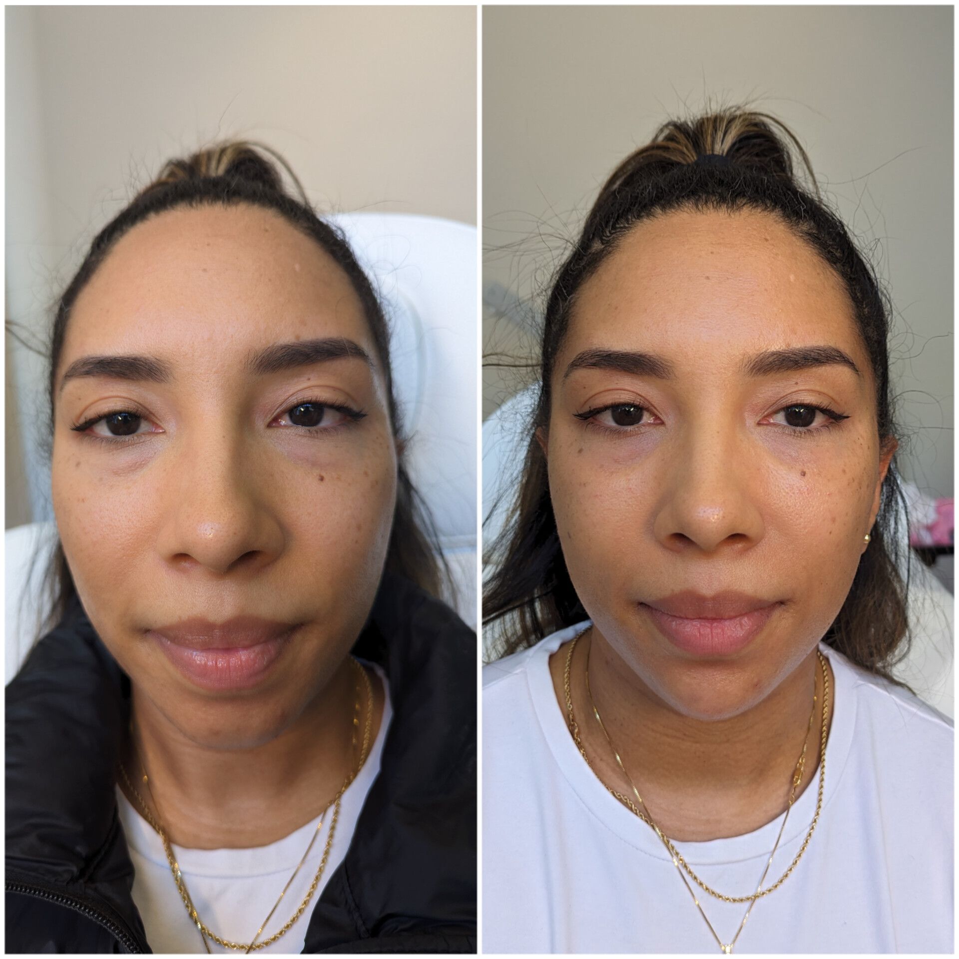 Chin projection improvement after dermal filler