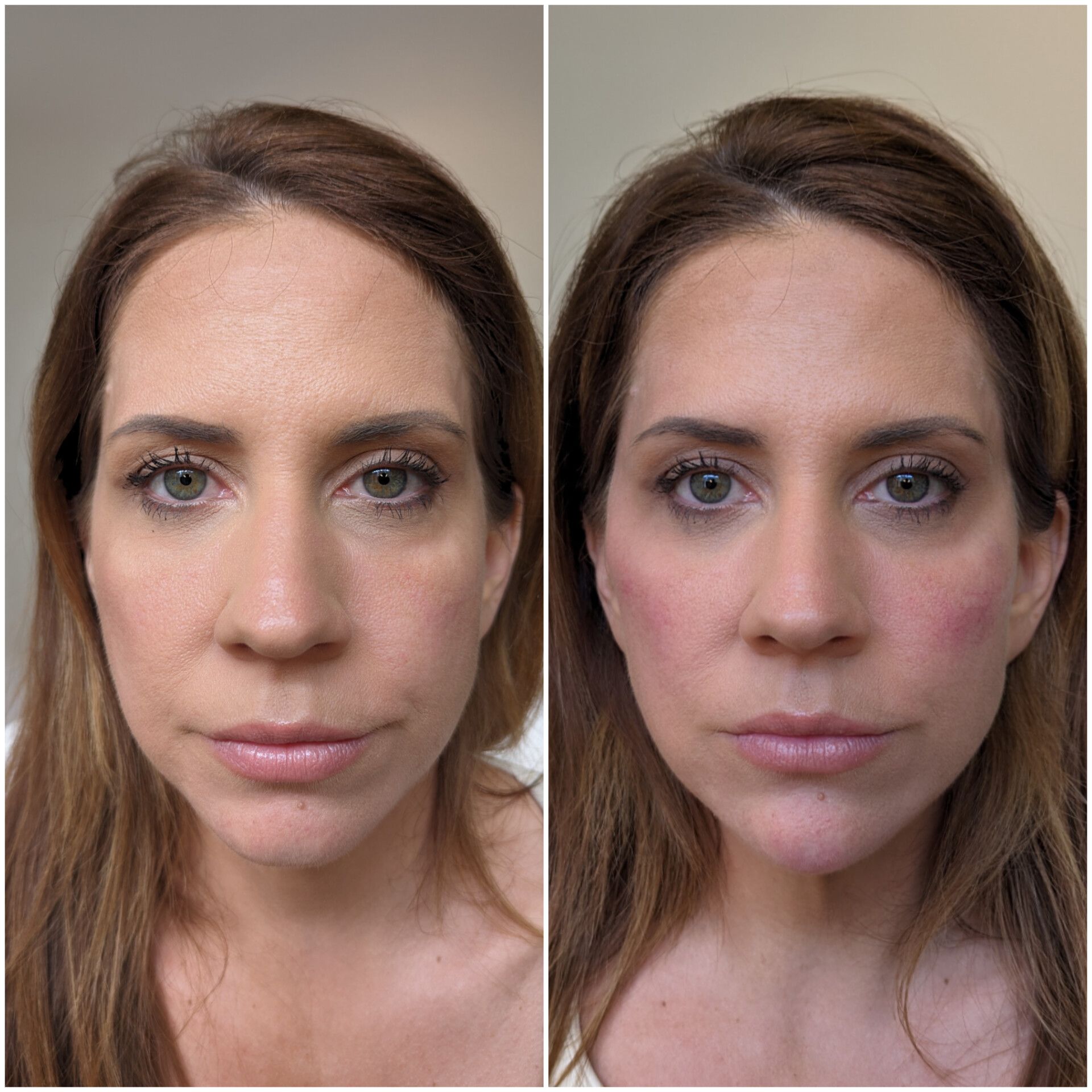 Full face rejuvenation
