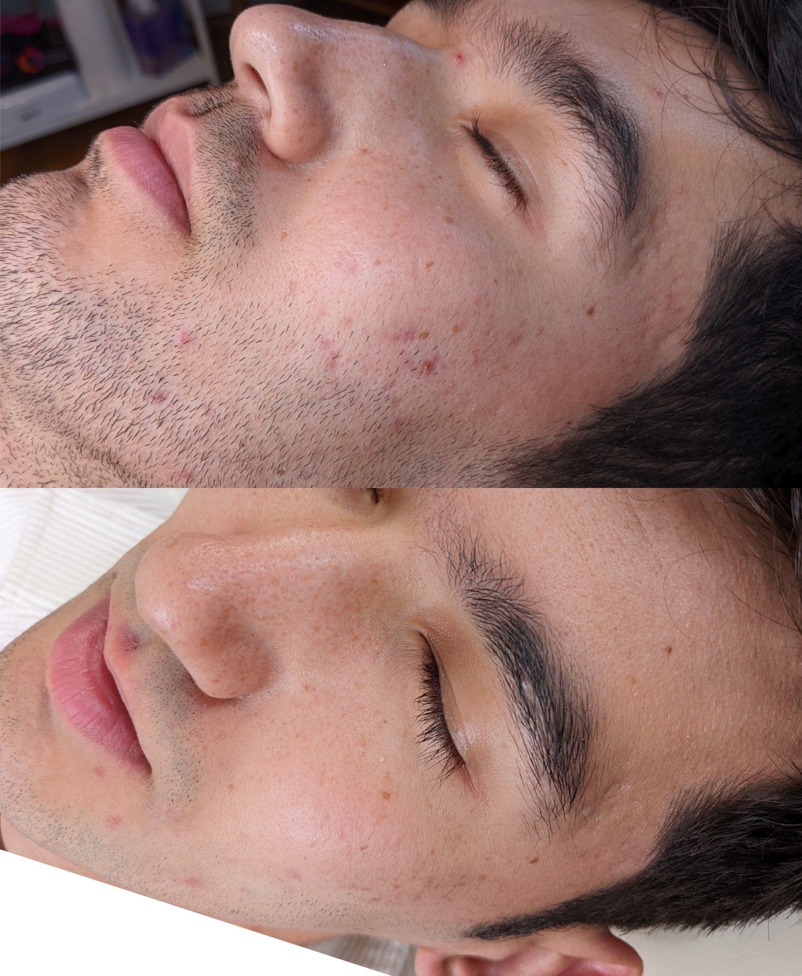 Microneedling before and after