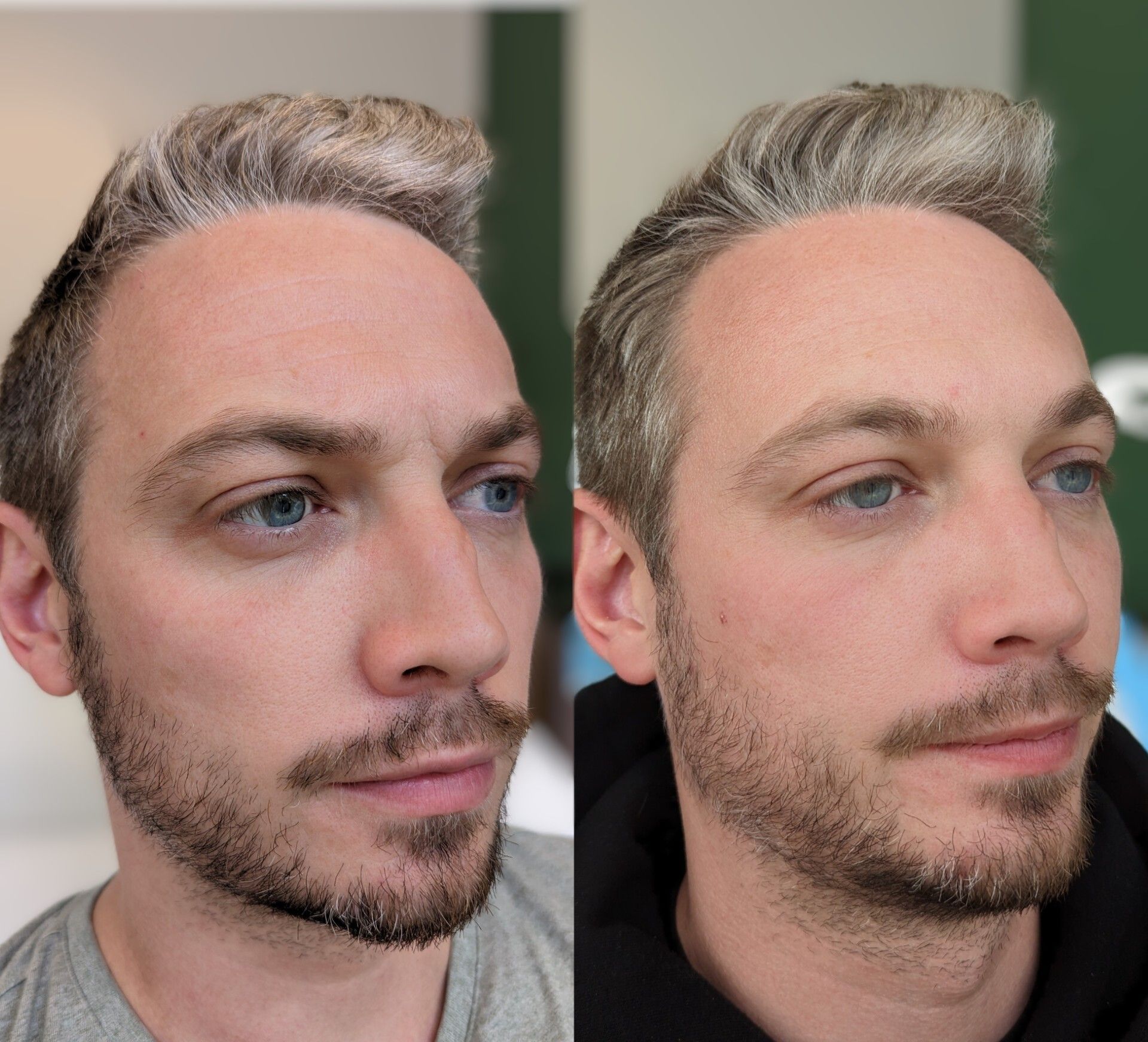 Side view showing sculpted jawline after filler treatment