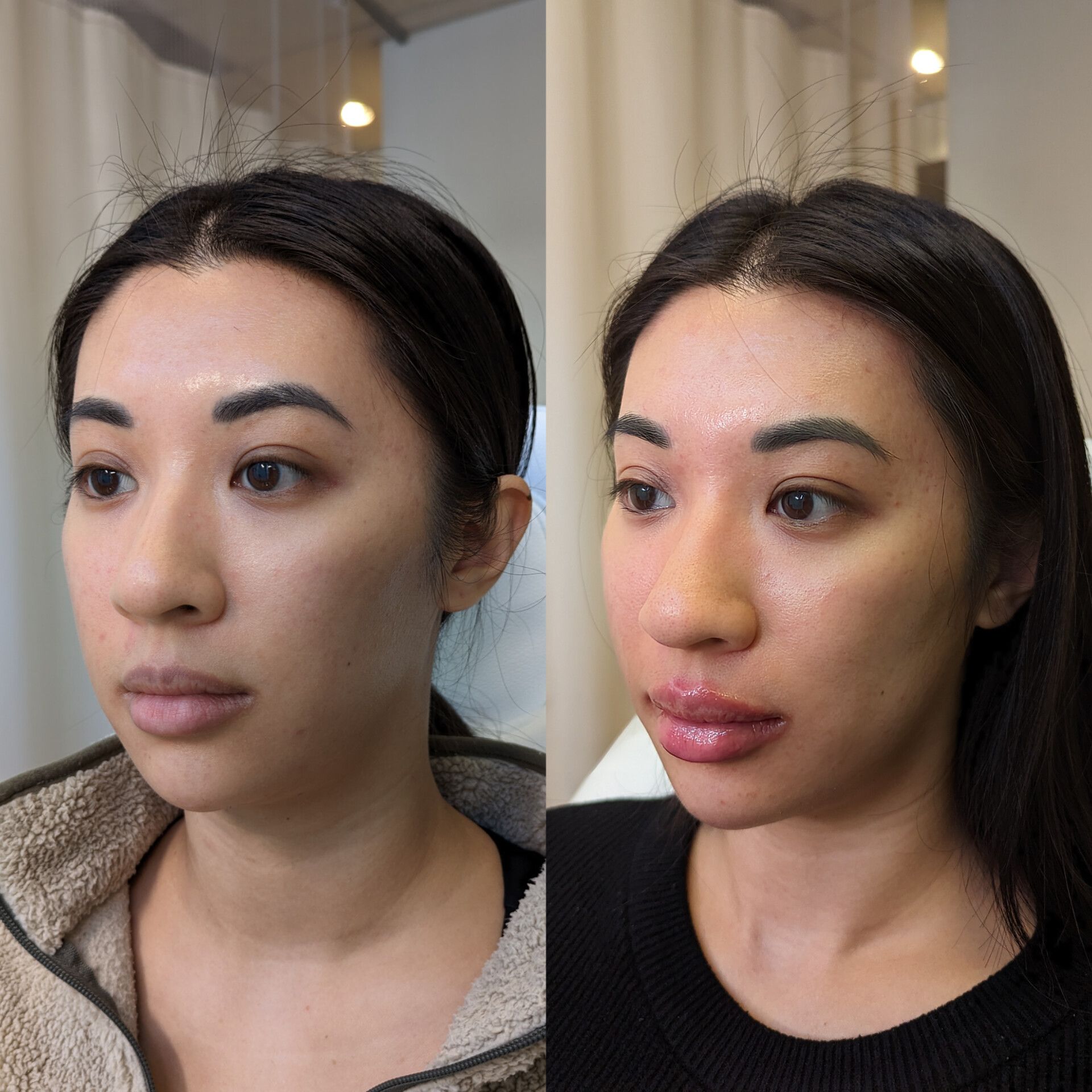 Cheeks and chin injection improving facial contour and balance