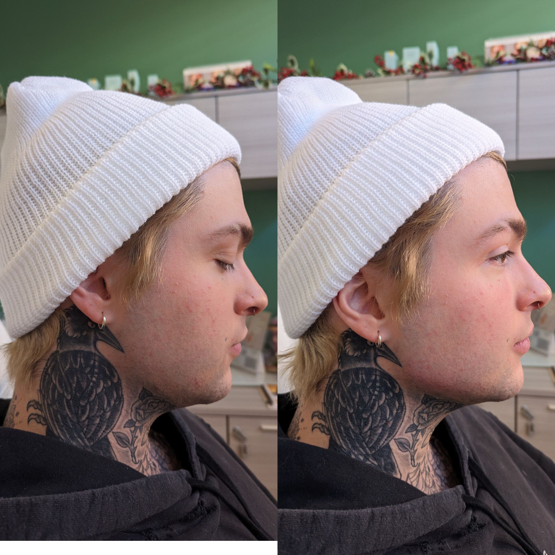 Profile view showing sculpted jawline after filler treatment