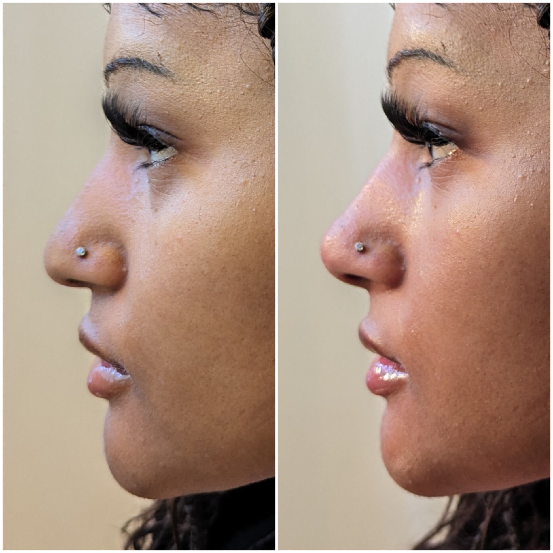 A before and after photo of a woman 's nose.