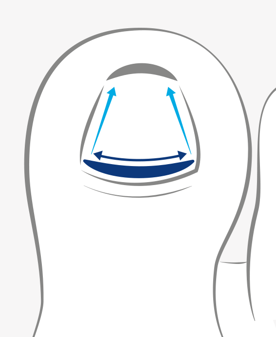 Diagram of a toenail with blue arrows showing expansion and contraction movements of the nail.