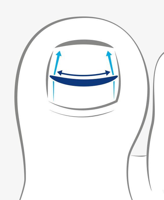 Toe with illustration of a curved, blue device lifting the toenail. Blue arrows indicate tension.