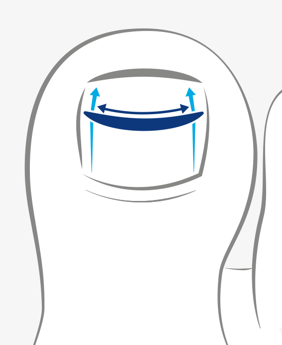 Illustration of a toenail with a curved insert, arrows indicate lifting the nail.