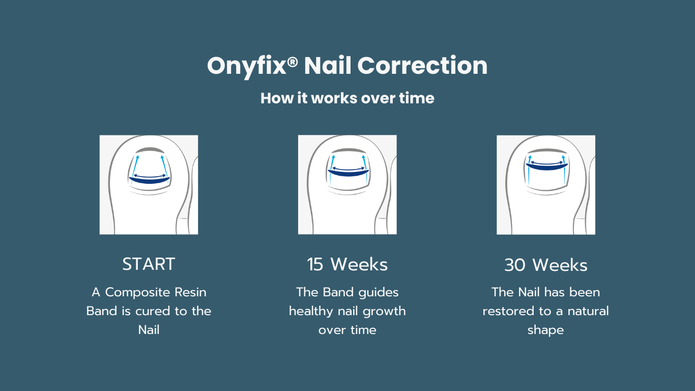 Onyfix treatment chart
