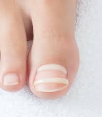 Close-up of a foot with two clear toe nail braces on the big toe, resting on a white surface.