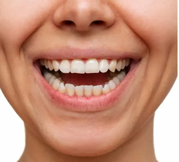 A close up of a woman 's mouth with her teeth showing